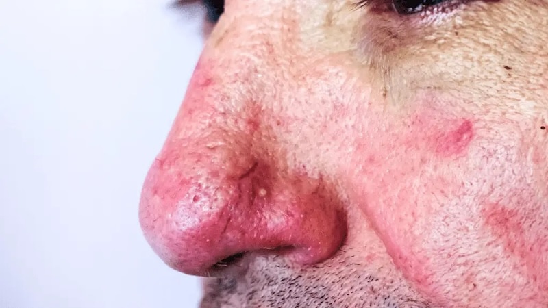 alcoholic nose
